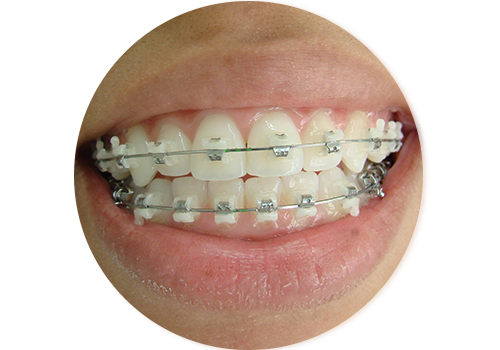 Aparelho Auto Ligado Estético